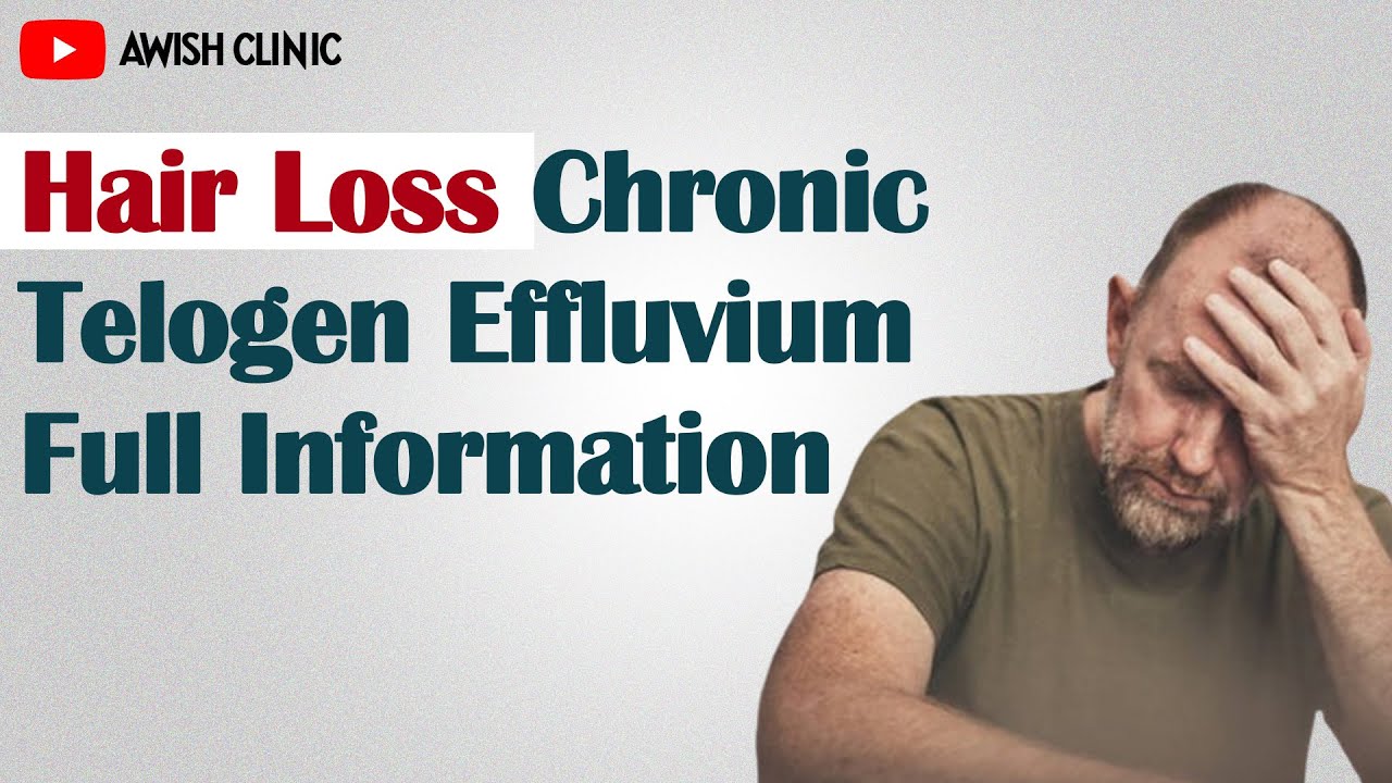 Chronic Telogen Effluvium | Hair Loss Ep-4| | By Dr. Vijay Kumar in Hindi