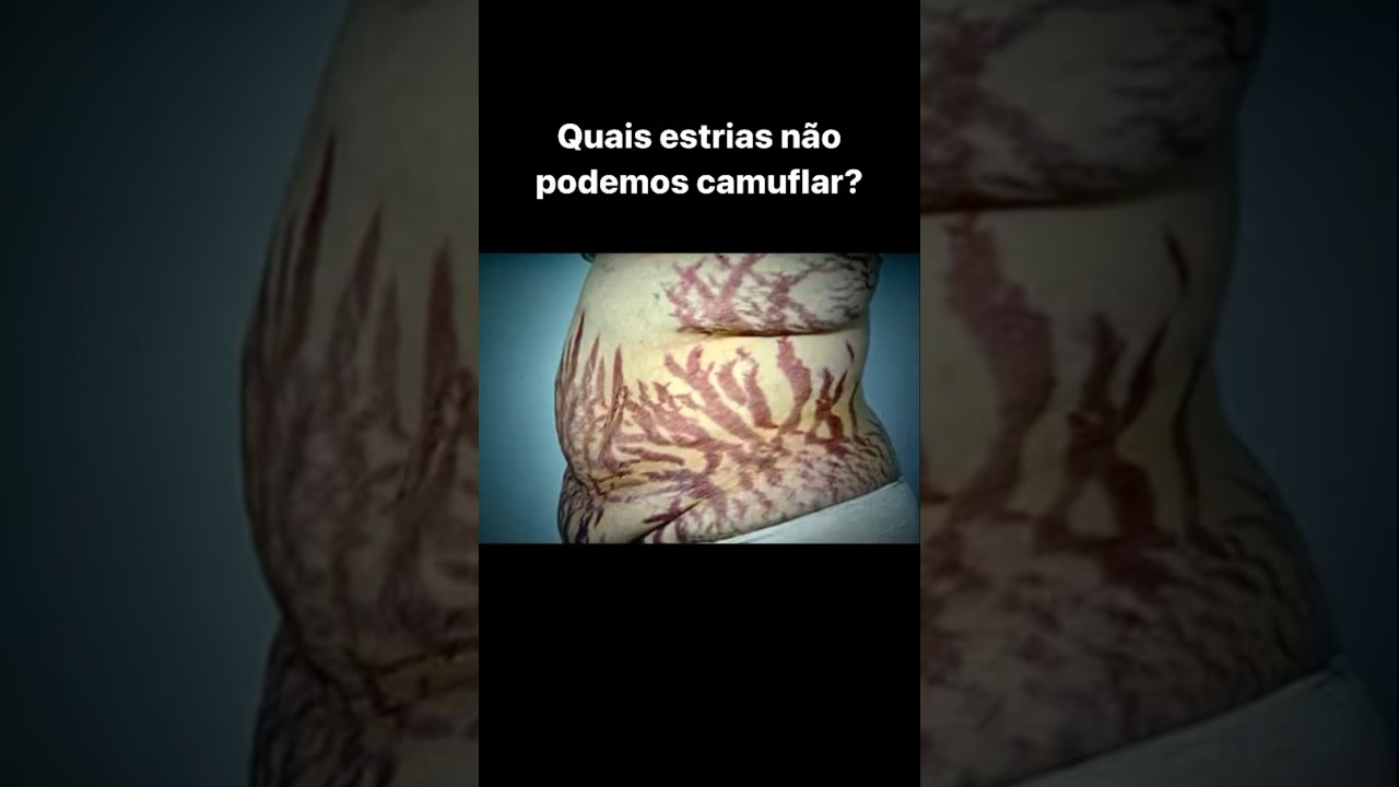 Se a sua estria n&atilde;o se encaixa nestes casos, ent&atilde;o voc&ecirc; pode fazer a #camuflagemdeestrias #estrias