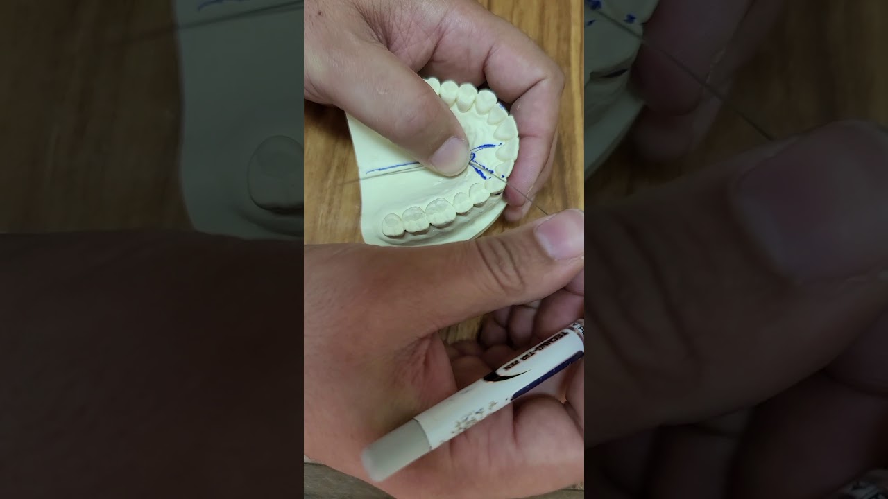 Simple finger spring/orthodontics