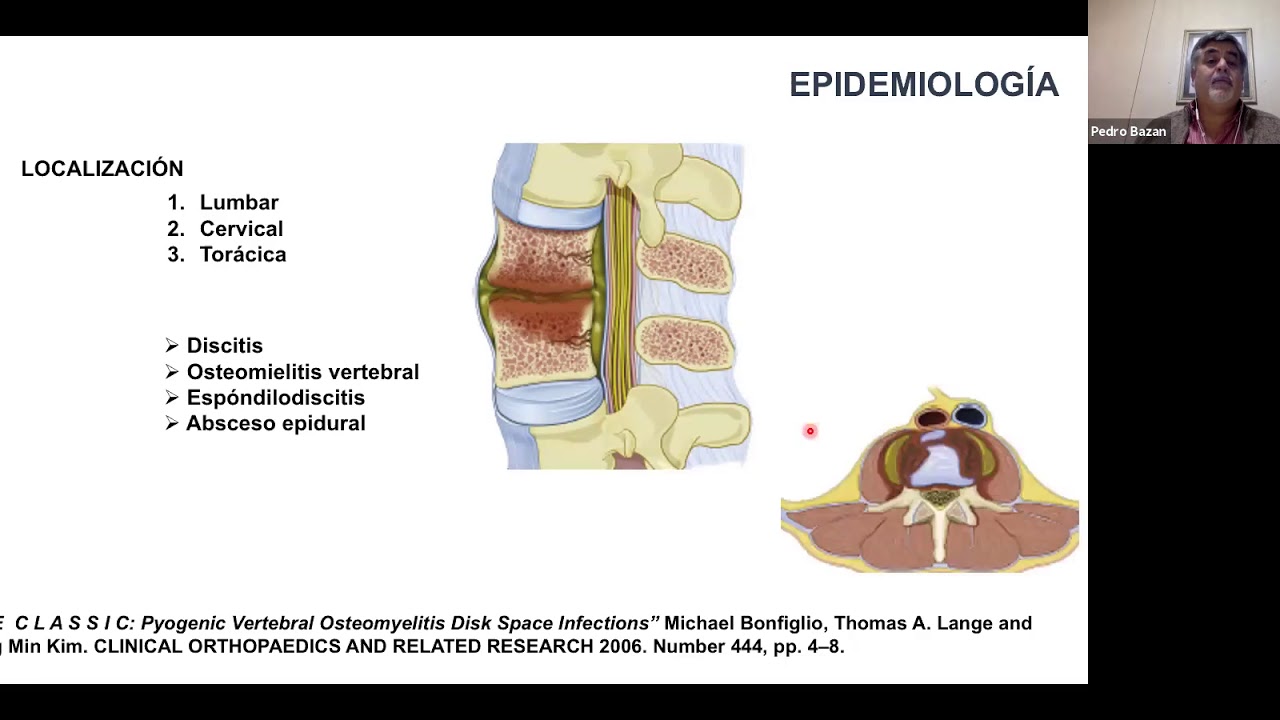 Espondilodiscitis