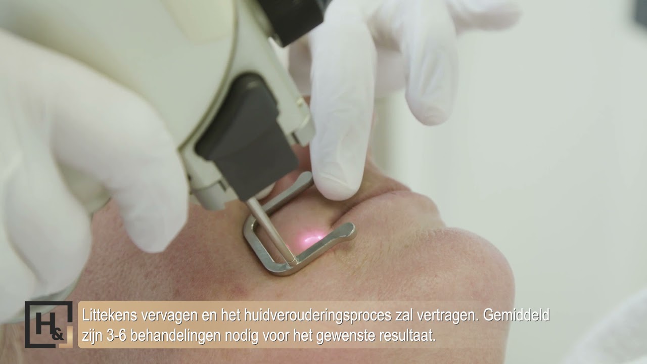 Huidverjonging en -verbetering bij Huid & Laser Utrecht