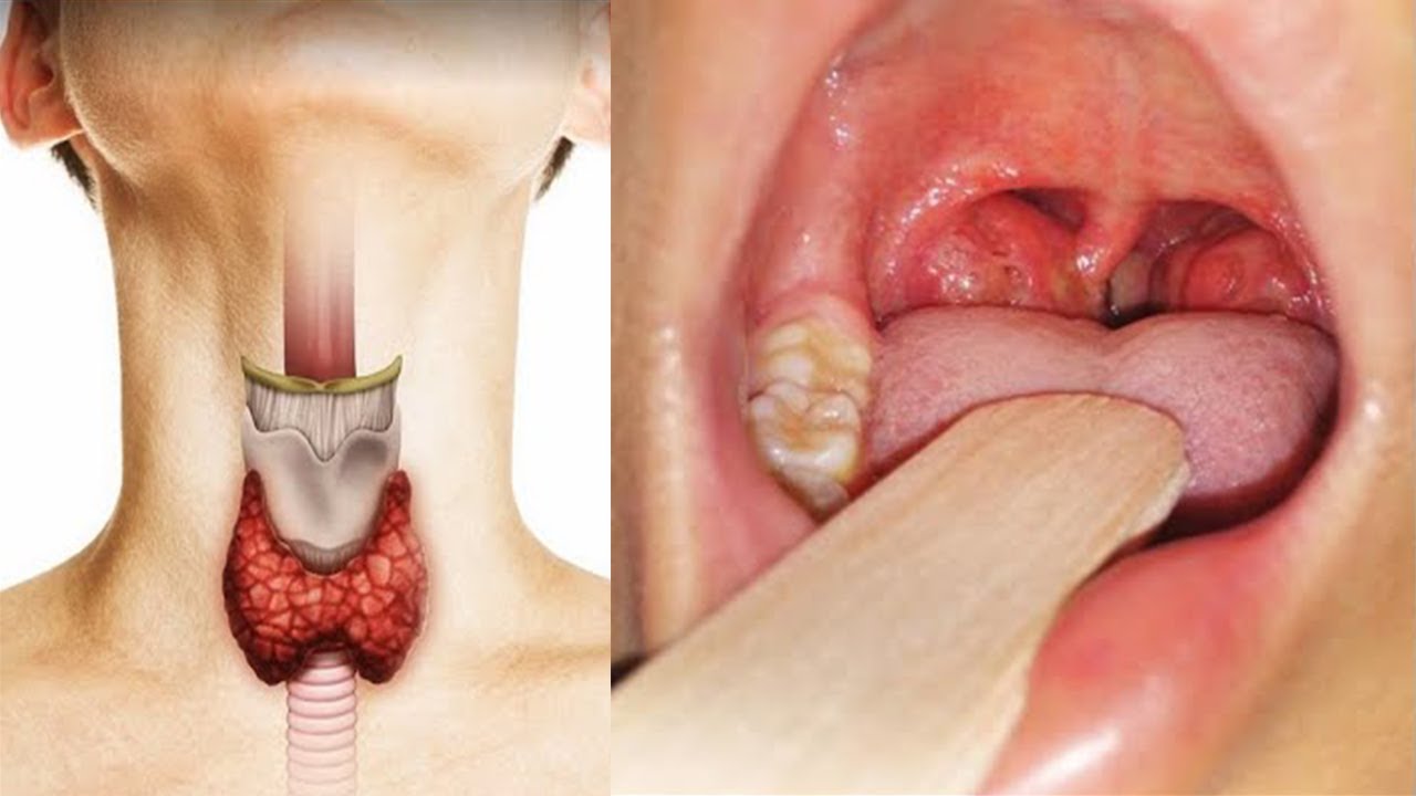 Kills throat pain and inflammation in 1 day! Thyroid function returns to normal