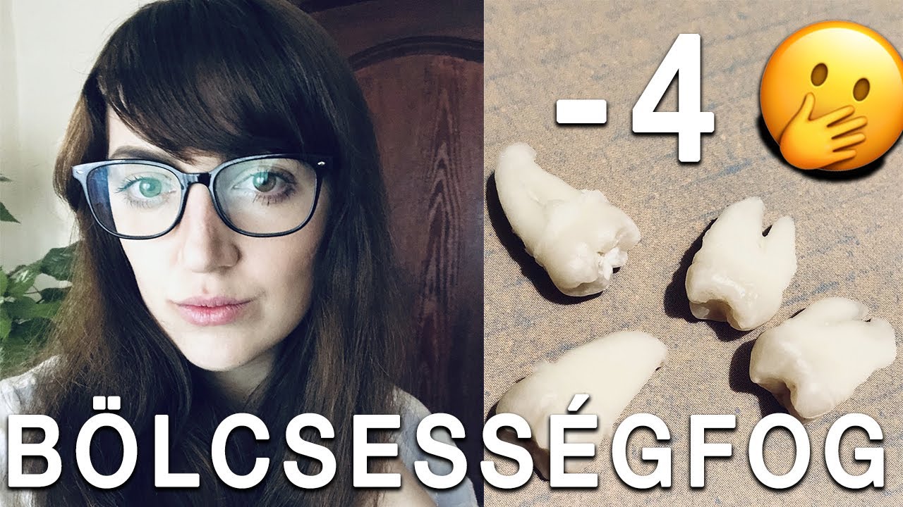 4 bölcsességfog eltávolítása egyszerre altatásban és regeneráció