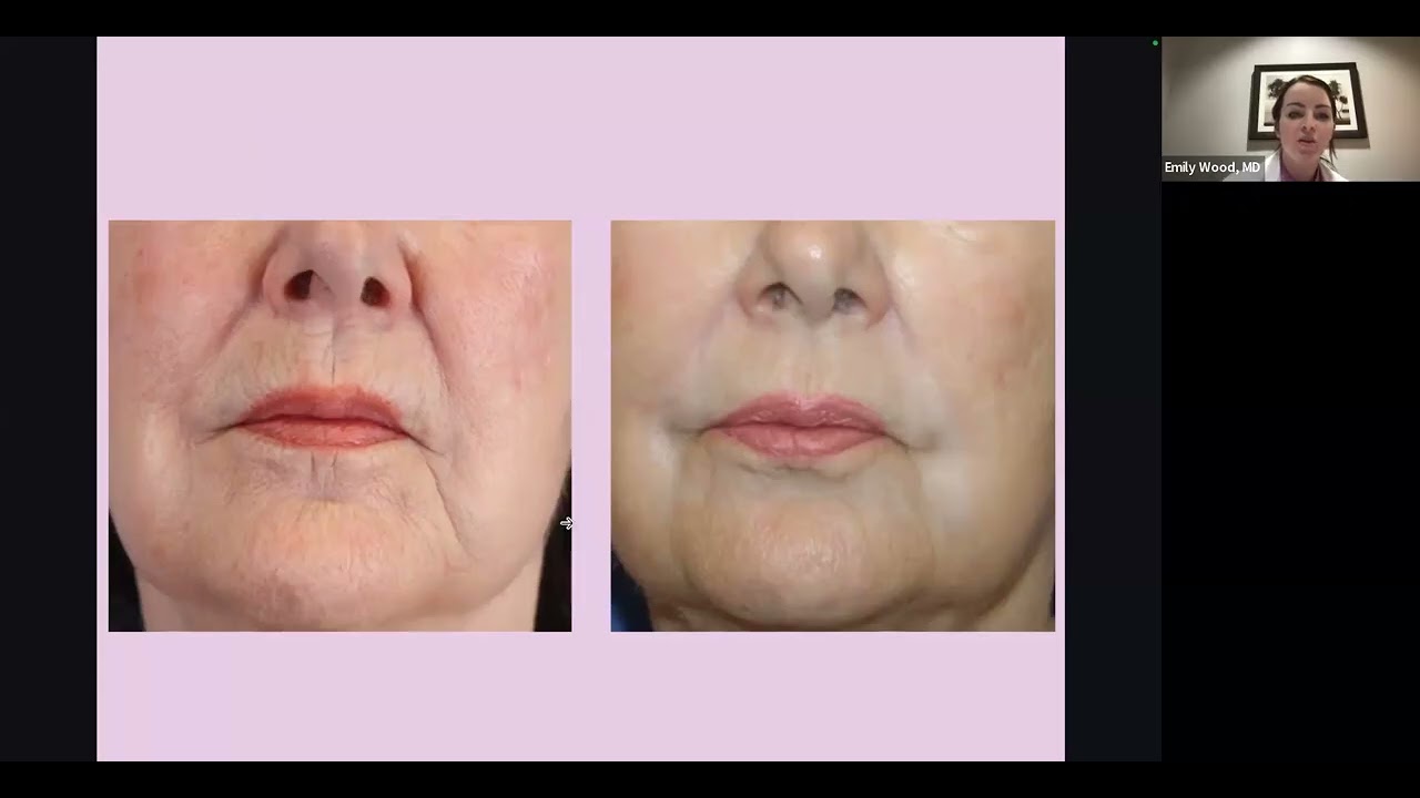 ActiveFX Laser Skin Resurfacing Explained - Dr. Emily Wood