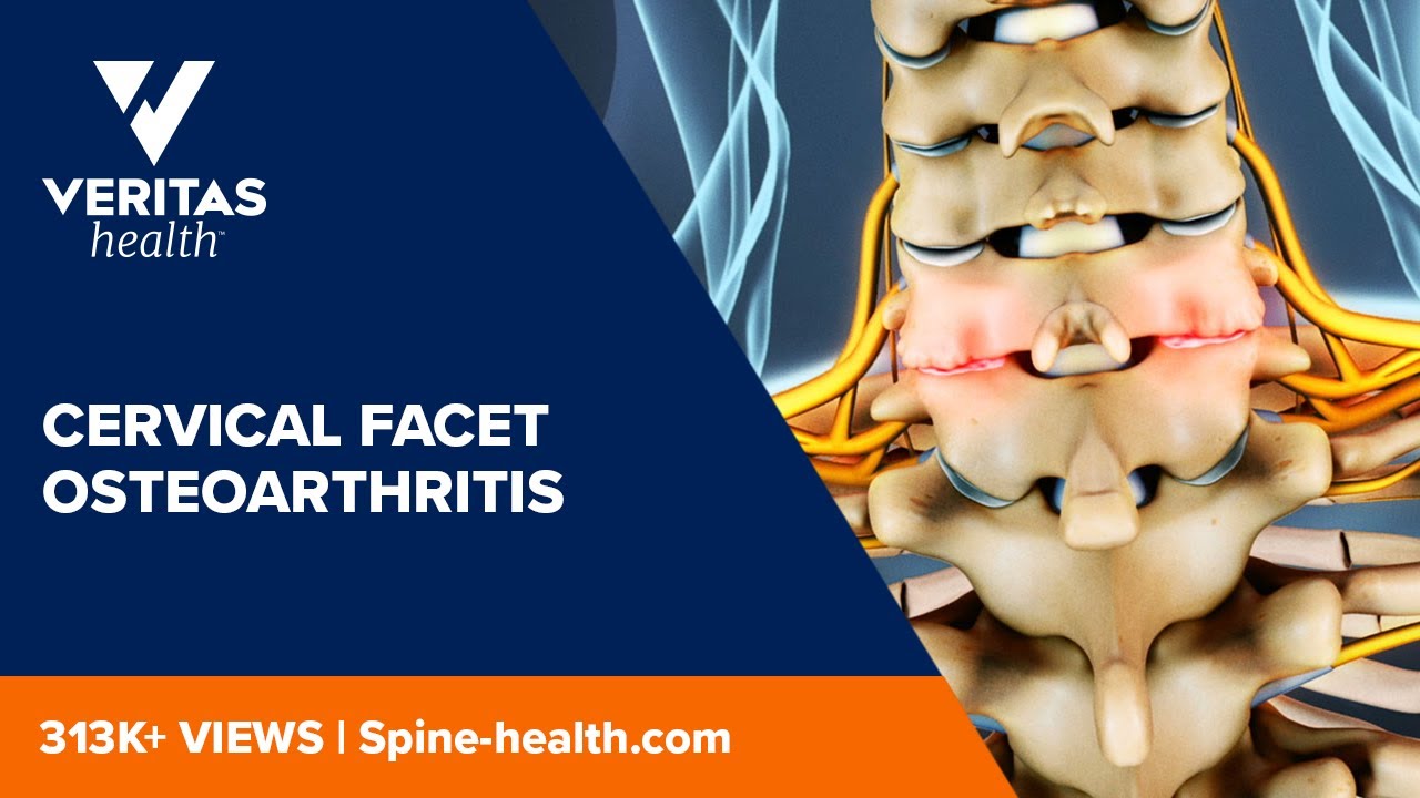 Cervical Facet Osteoarthritis