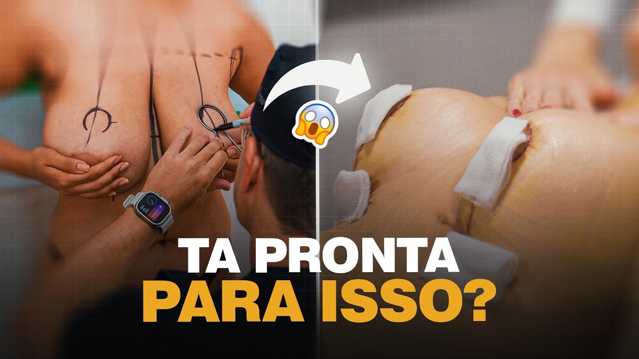 Mastopexia: É Para Mim? Quem Deve Fazer, Quem Não Deve e Por Quê | Dr Ícaro Samuel