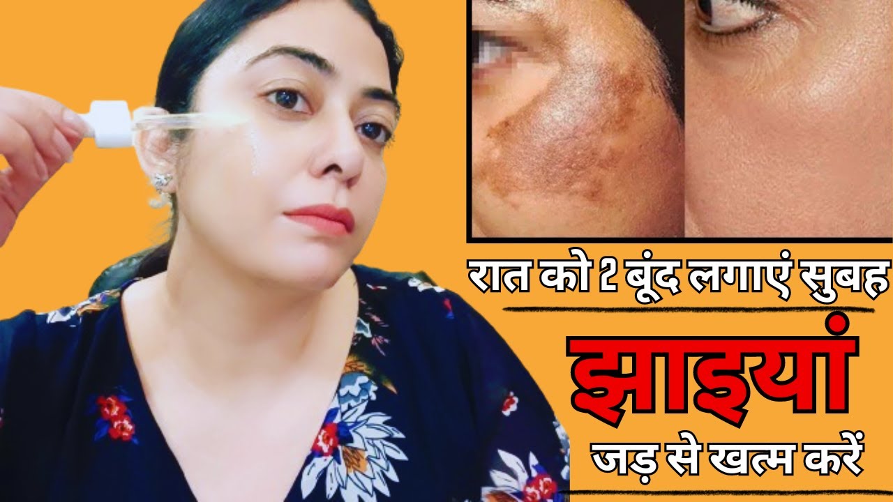 कितनी भी पुरानी झाइयां, काले दाग-धब्बें जड़ से खत्म करो || How to Remove Pigmentation Permanently