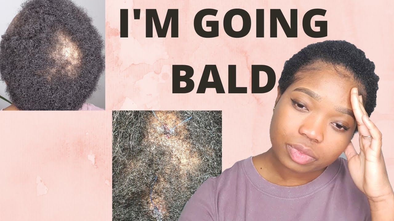 MY HAIR LOSS JOURNEY PART 1 |DIAGNOSED WITH CCCA ALOPECIA | SCALP BIOPSY