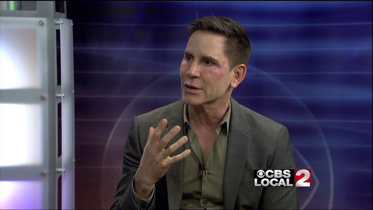 Dr. Timothy Jochen Discusses Treatment for Scars