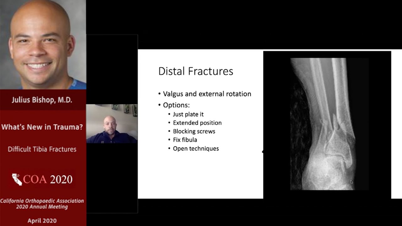Difficult Tibia Fractures - Julius Bishop, MD