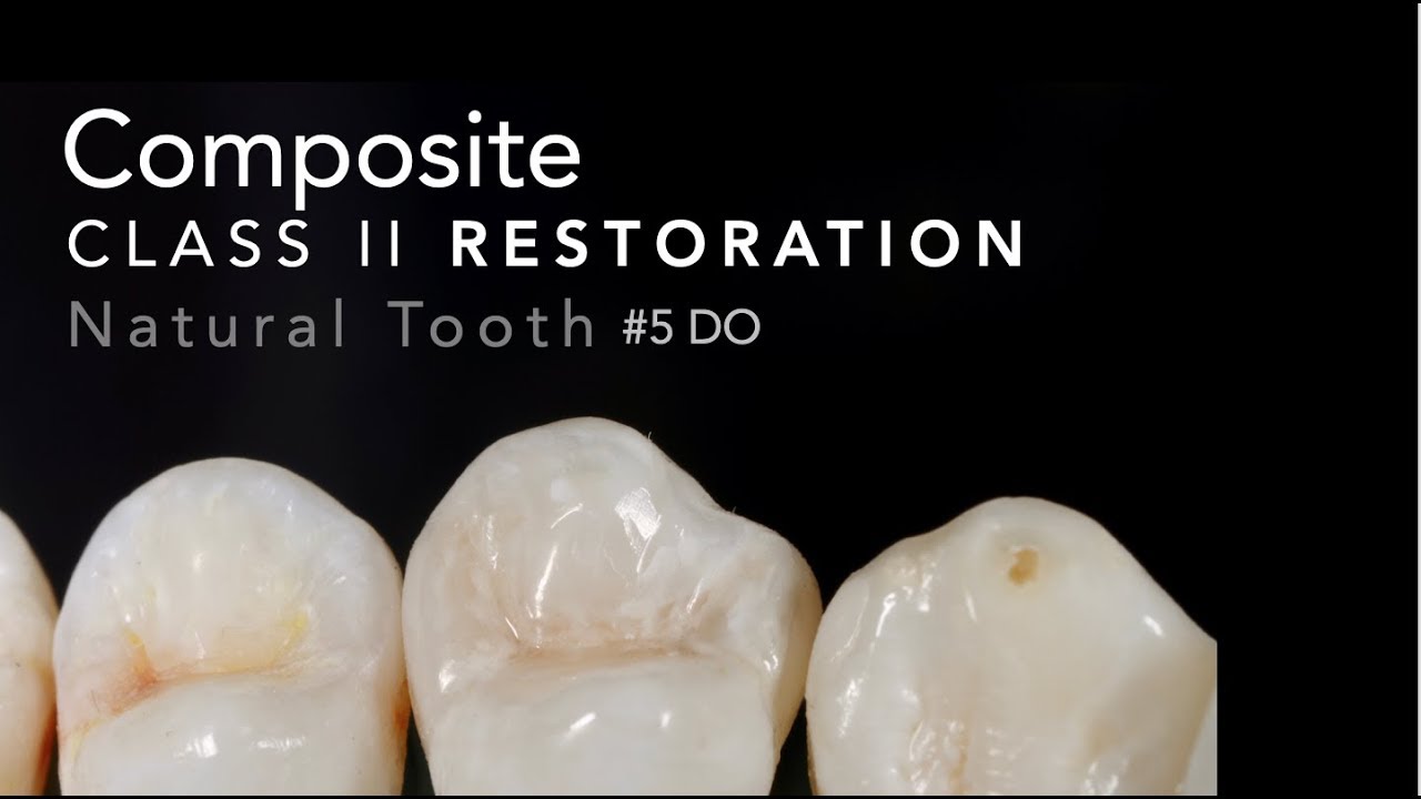 Class II Composite Restoration - #5 DO Natural Tooth
