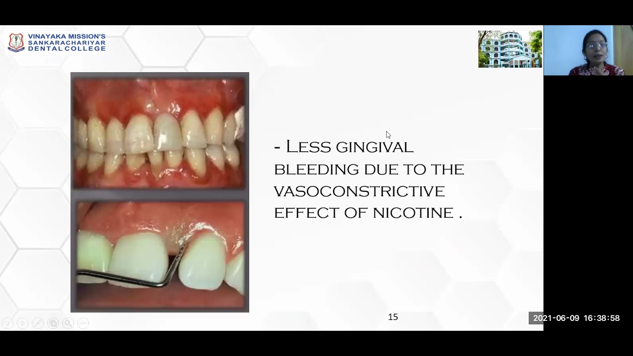 Dr Priya   Smoking and Periodontal Disease