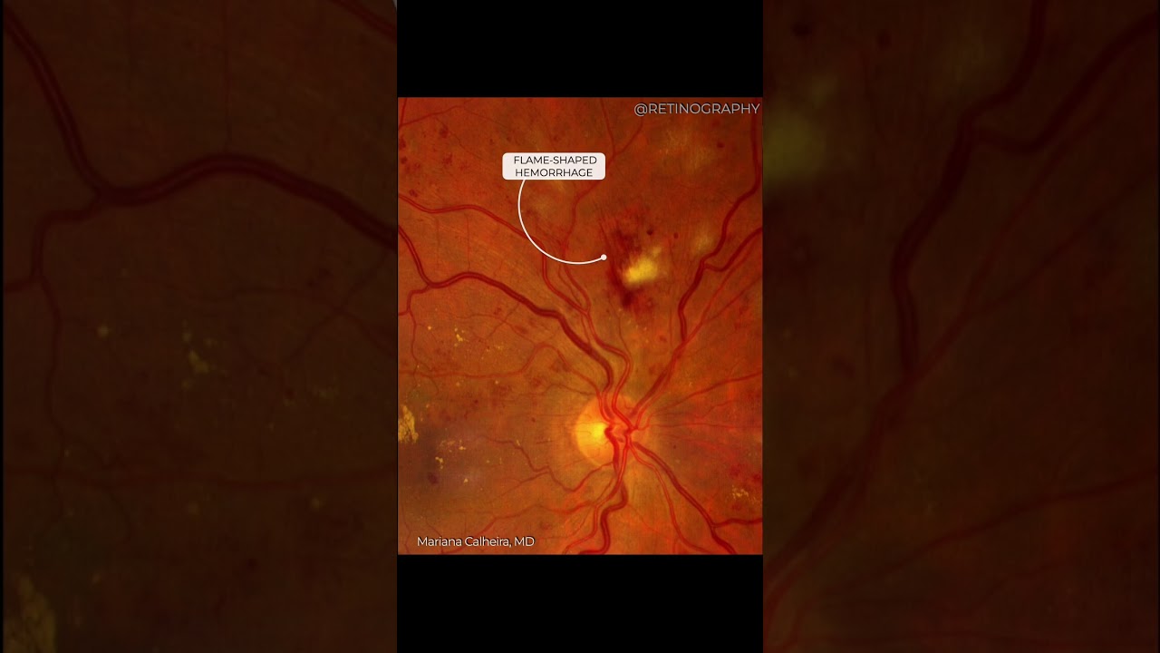 HYPERTENSIVE RETINOPATHY FUNDUS IMAGE ANALYSIS For more images like this visit www.retinography.org