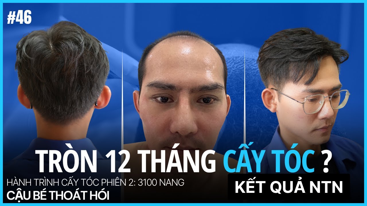 12 tháng sau cấy tóc kết quả thành công như thế nào? #46 l Hành Trình Cấy Tóc
