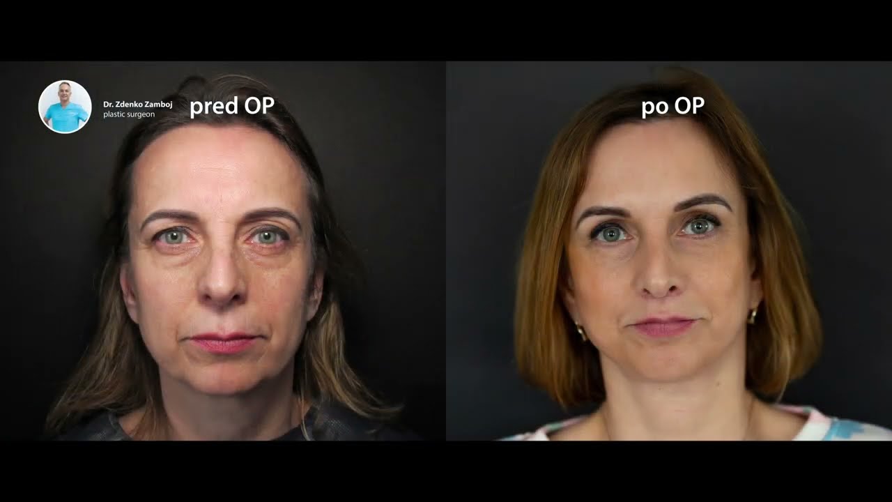 ⁠Facelifting - chirurgický lifting tváre a krku, Dr. Zamboj