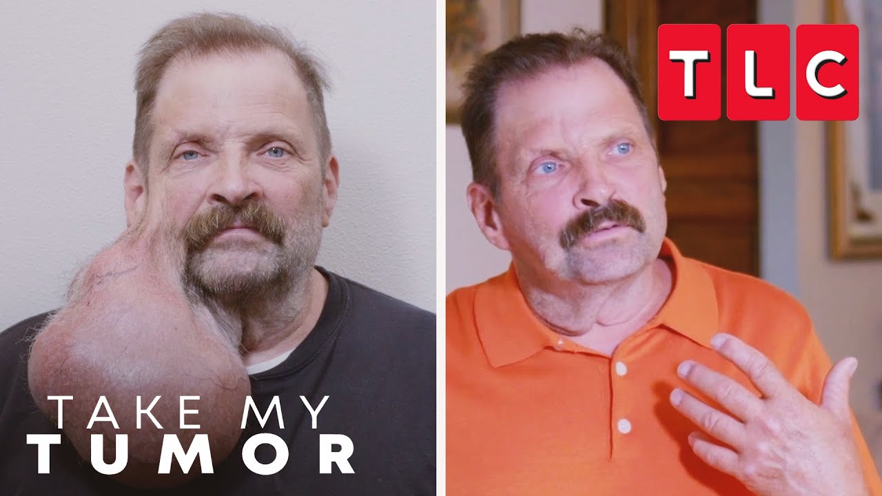 Tim Is Unrecognizable After His Tumor Removal | Take My Tumor | TLC
