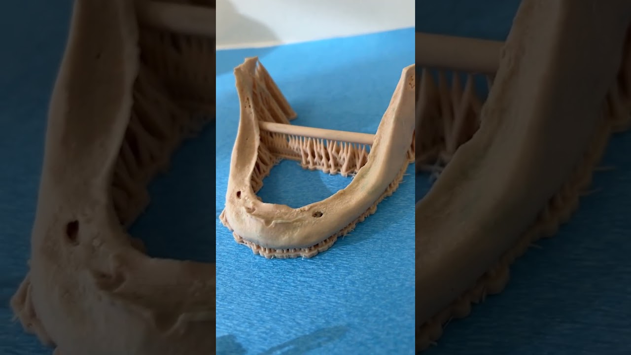 Rare Custom Subperiosteal Dental Implant to Treat Severe Bone Loss of the Lower Jaw