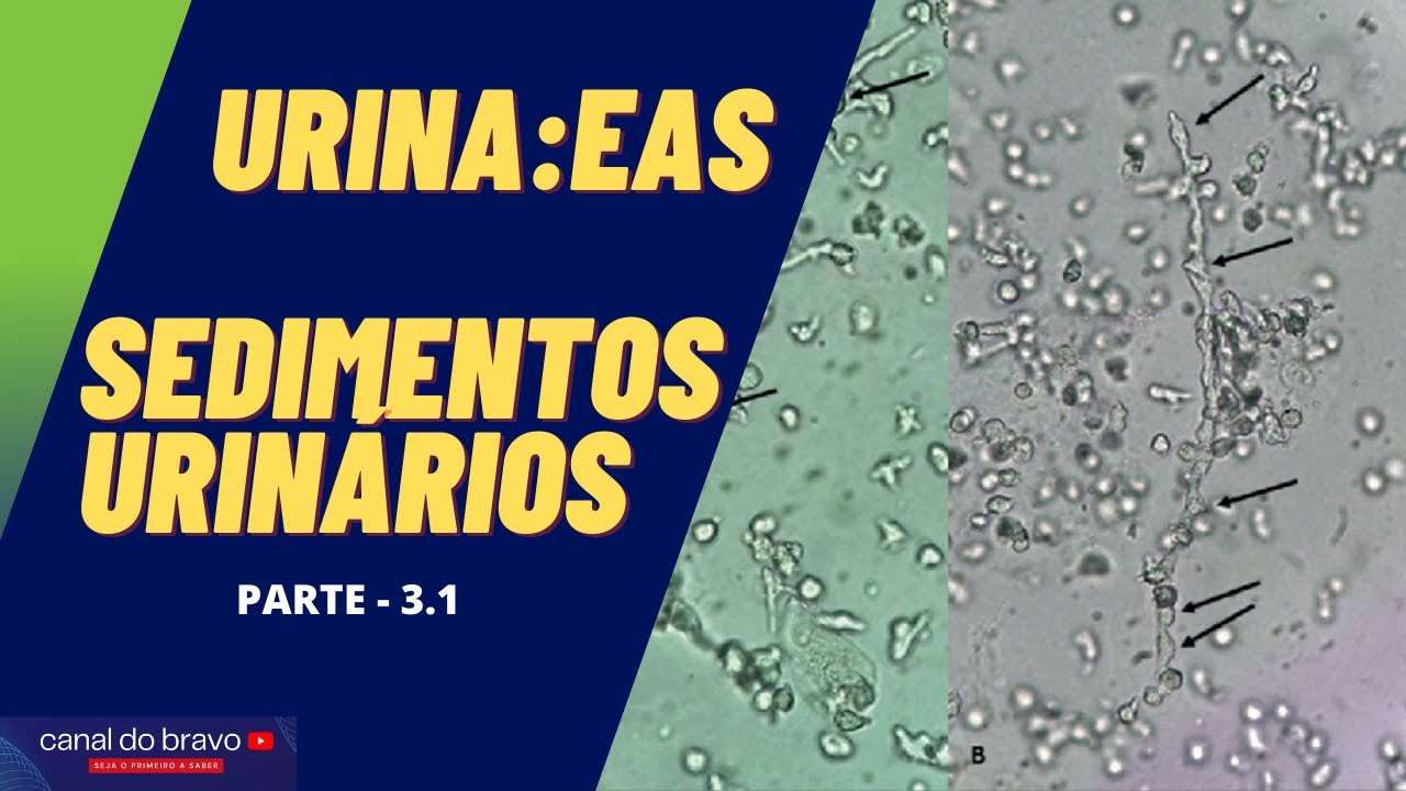 Urinálise na prática: EAS - Sedimentoscopia parte 1