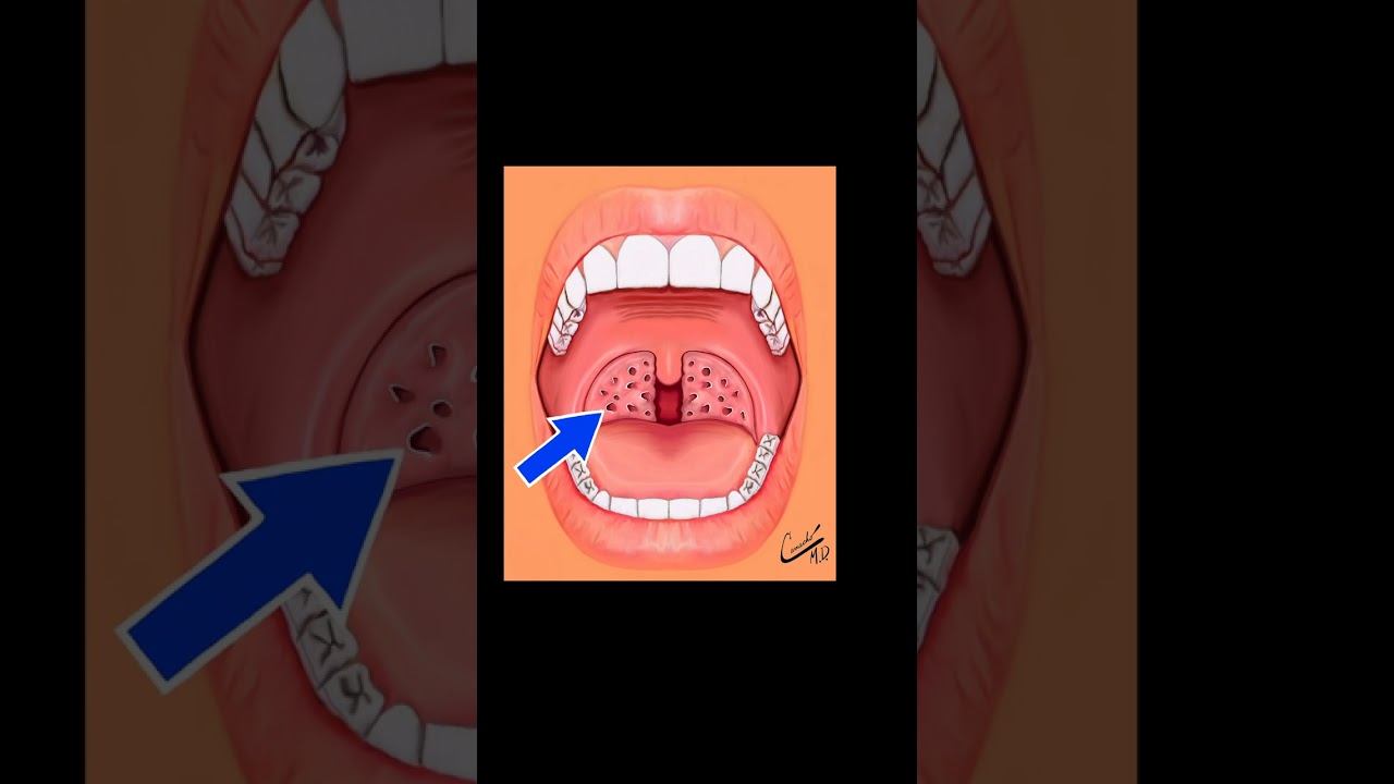 TONSIL STONES #shorts