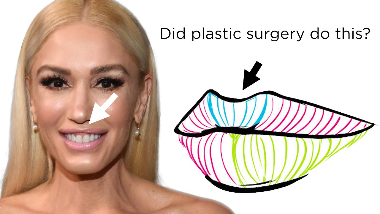 What Happened to Gwen Stefani&rsquo;s Face? Newport Beach Plastic Surgeon explains