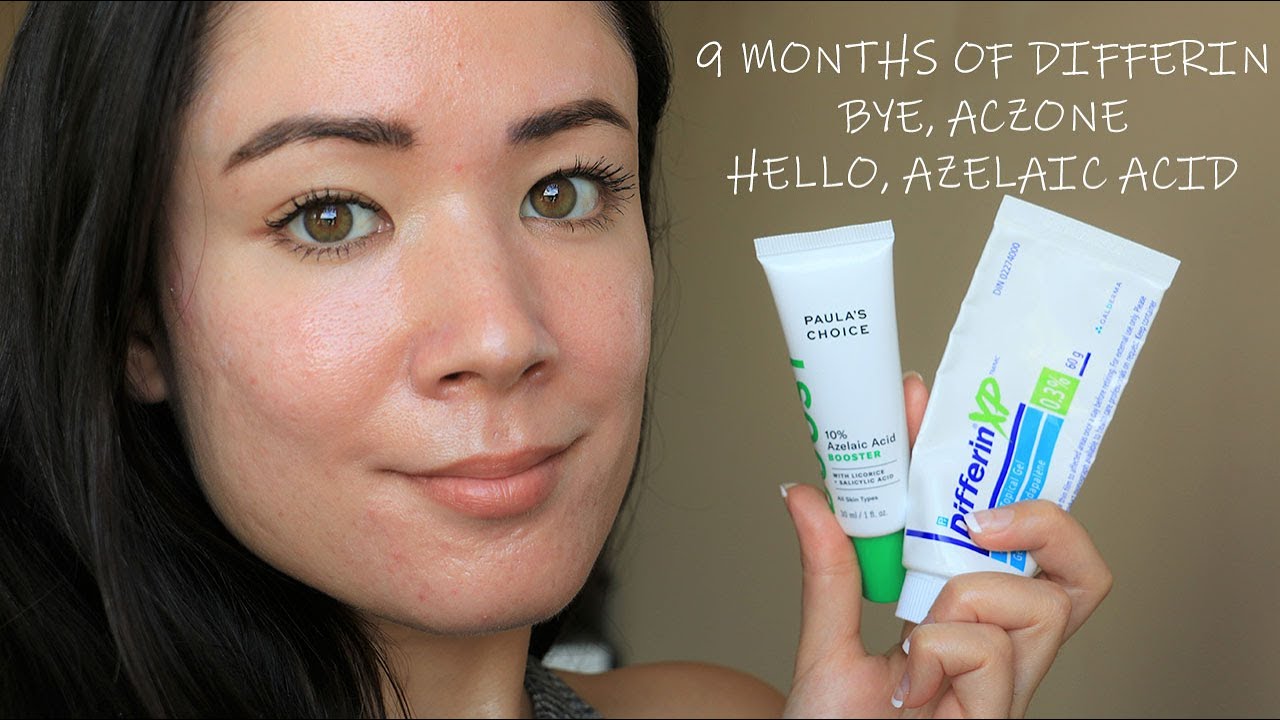 👧🏻 SKIN UPDATE [#2]: 9 Months of Differin, Before + Afters of Acne Scars | MICHXMASH