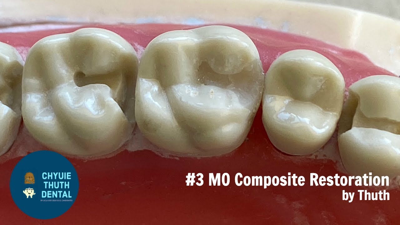 [ChyuieThuth] #3 MO Class 2 Composite Restoration