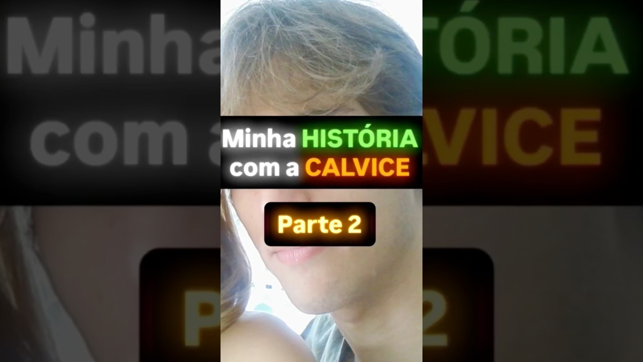 Minha hist&oacute;ria com a calvice - parte 2 #careca #cabelo #alopecia #minoxidil #calvo #calvice