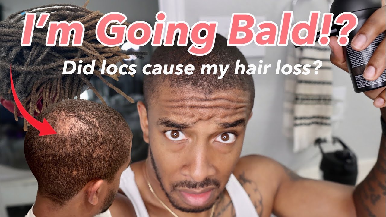 Did Dreadlocks Cause My Alopecia Areata?!😱🤯 | Trying Toppik Hair Fibers😣😓 #dreadlockjourney