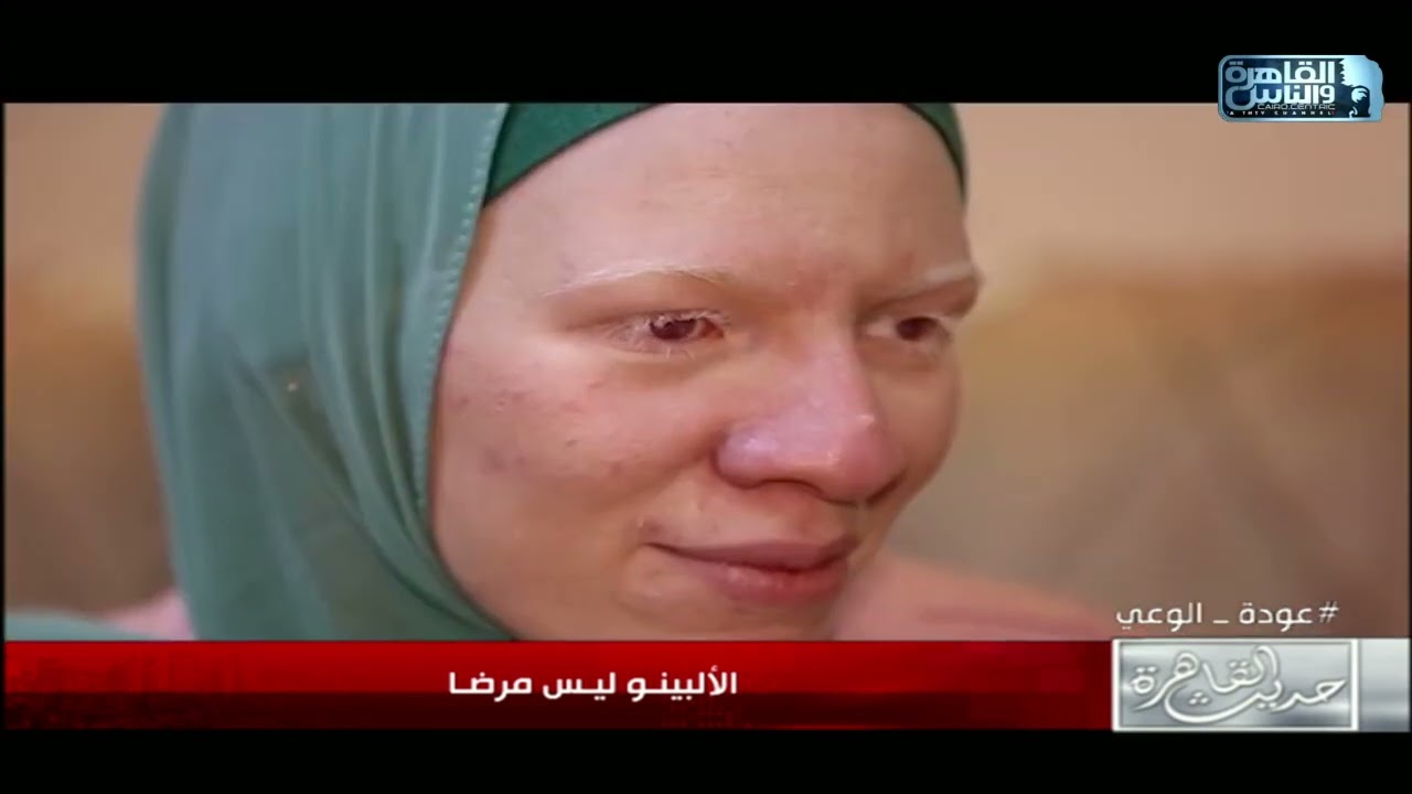 الألبينو ليس مرضا!