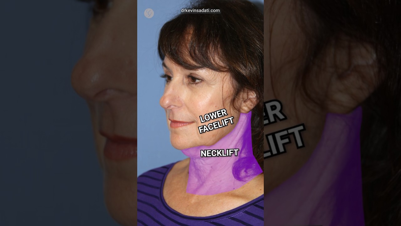 Turkey Neck ➡️ Snatched Jawline |  Lower Facelift + Neck Lift #beforeandafter #antiaging #cosmetic