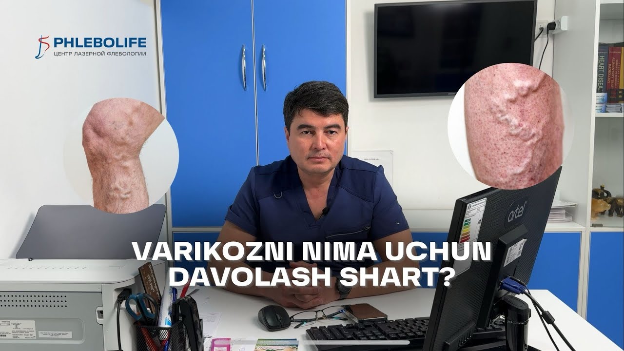 VARIKOZNI davolashni KECHIKTIRMANG | Operatsiyaga yo'llanma olganlar uchun