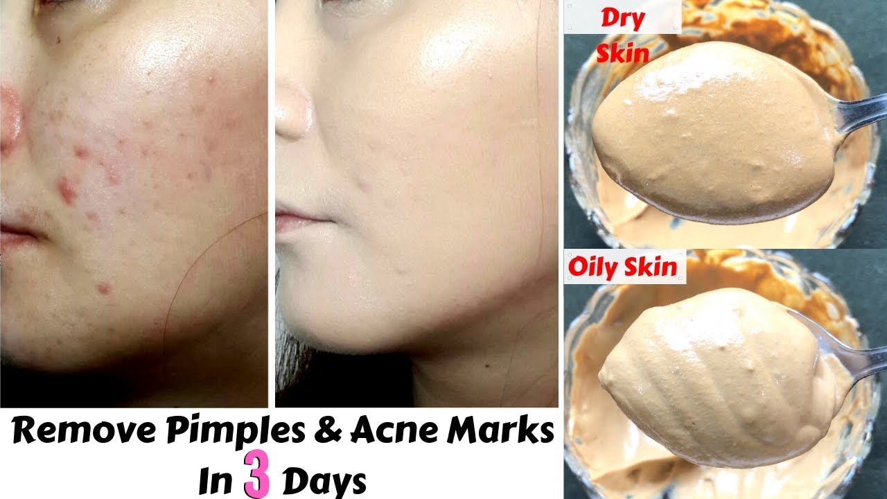 MULTANI MITTI FACE PACK | Best For Summers | Remove Pimples, Sun Tan & Dark Spots | 100% Works
