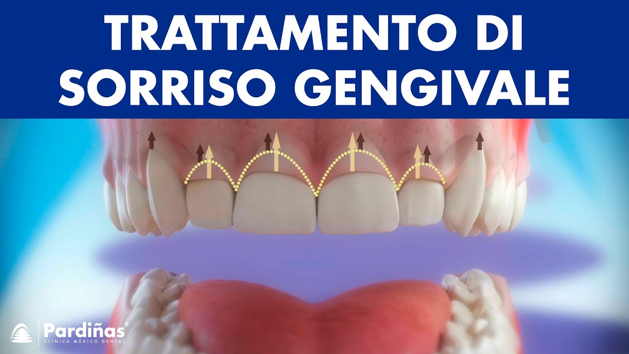 Gengivectomia - Trattamento di sorriso gengivale ©