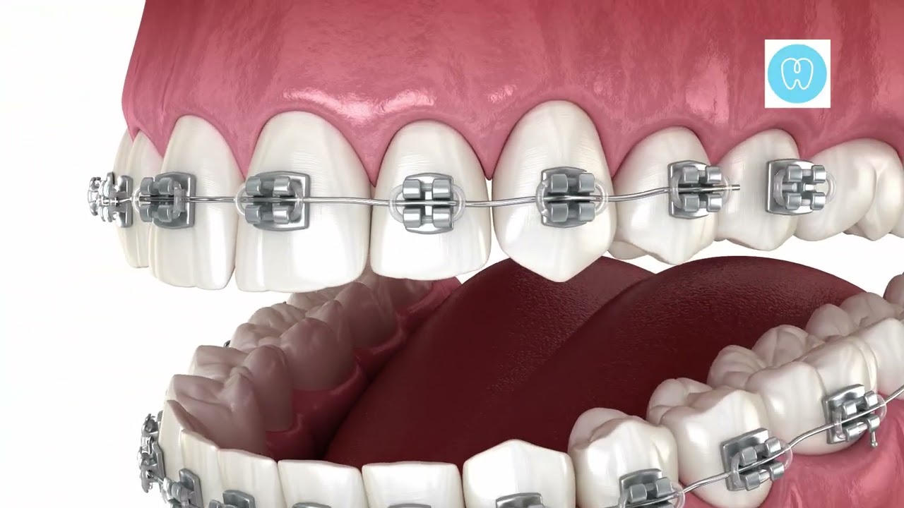 Clear Aligners vs Braces: Which Is Better? | Family First Smiles in Leesburg VA