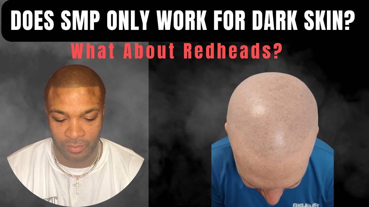 Does SMP Only Work for Dark Skin? | What About Redheads?
