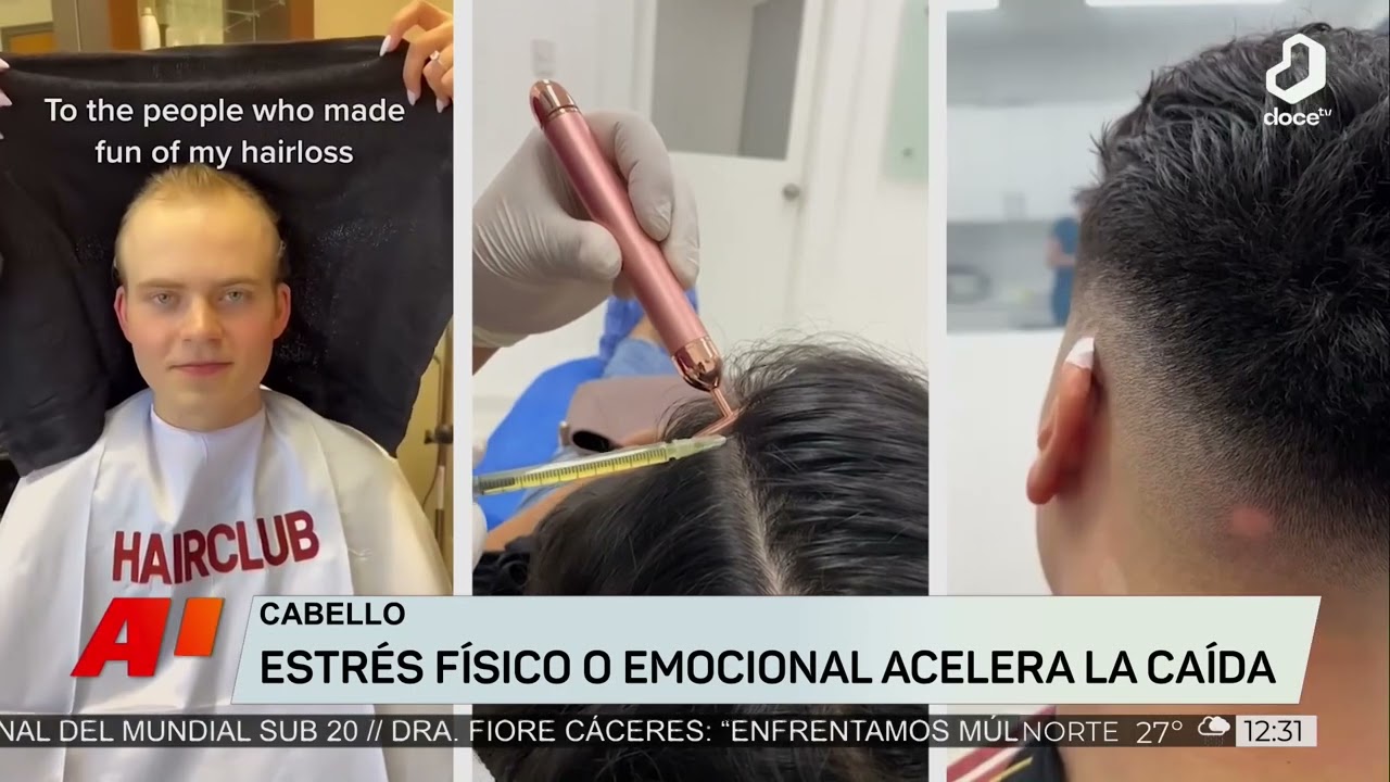 #AlMediod&iacute;a: aumento de la calvicie en hombres de 25 - 30 a&ntilde;os