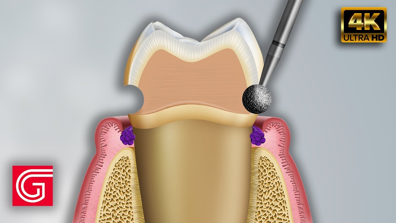 How to Prepare Teeth for Crown and Bridge by Michael DiTolla, DDS, FAGD