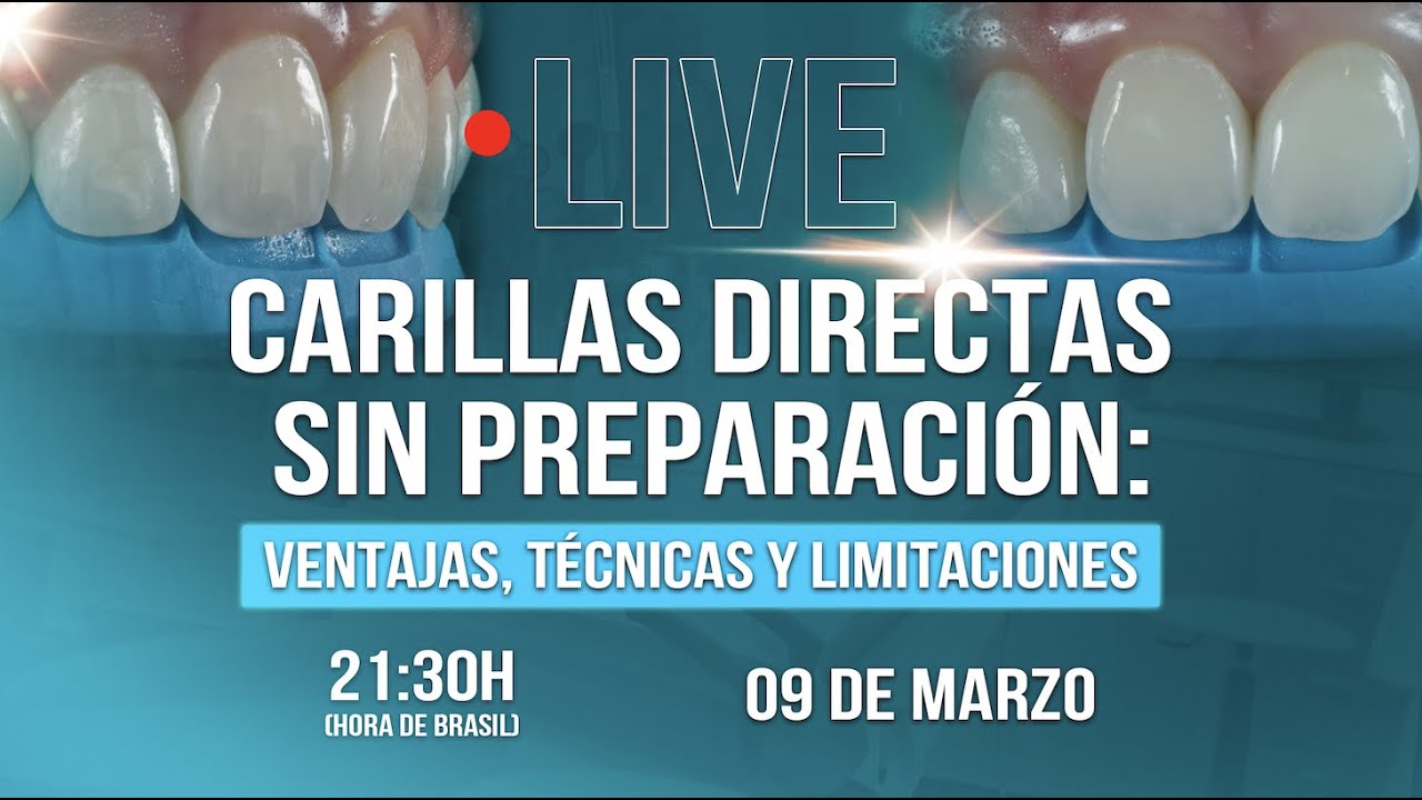 Carillas Directas sin preparación: Ventajas, Técnicas y Limitaciones