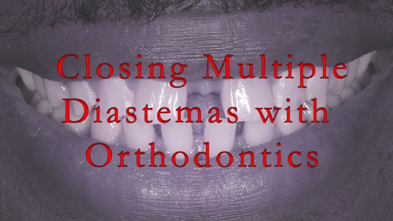 Closing Multiple Diastemas With Orthodontics
