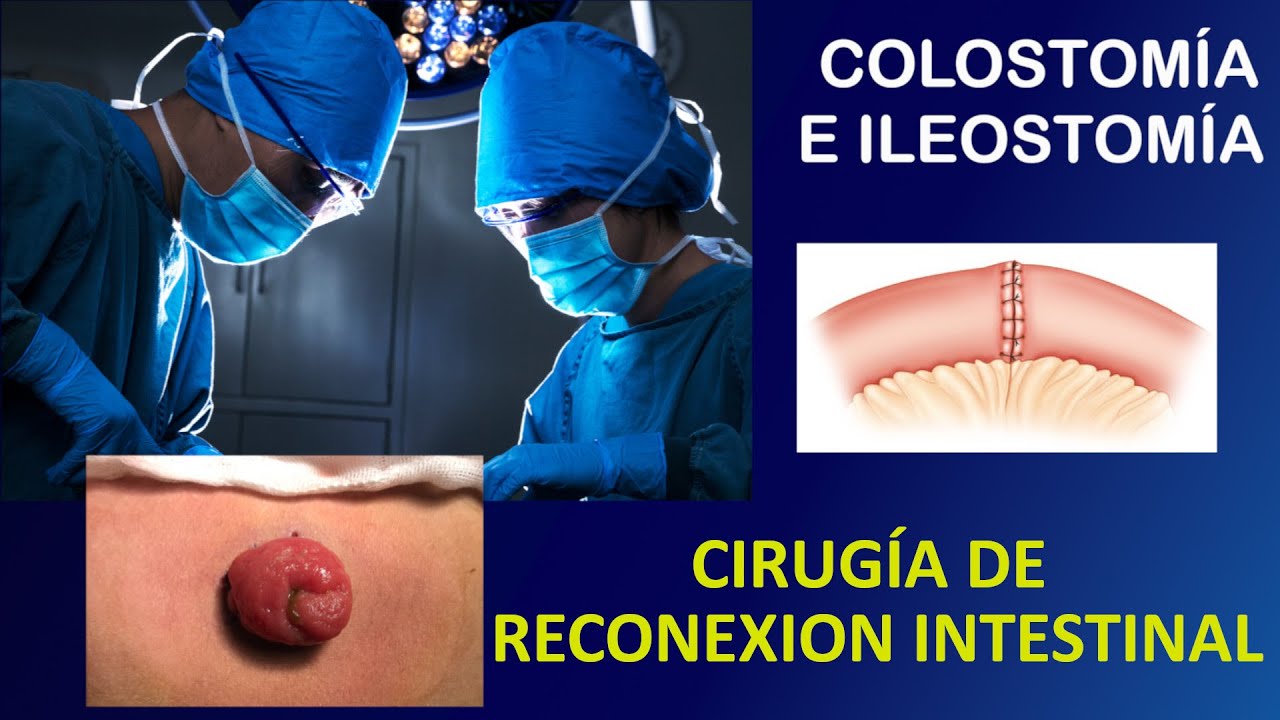 ☑️ Cirug&iacute;a de 𝗥𝗘𝗖𝗢𝗡𝗘𝗫𝗜𝗢́𝗡 𝗜𝗡𝗧𝗘𝗦𝗧𝗜𝗡𝗔𝗟 de una 𝐈𝐥𝐞𝐨𝐬𝐭𝐨𝐦𝐢́𝐚 𝐨 𝐂𝐨𝐥𝐨𝐬𝐭𝐨𝐦𝐢́𝐚