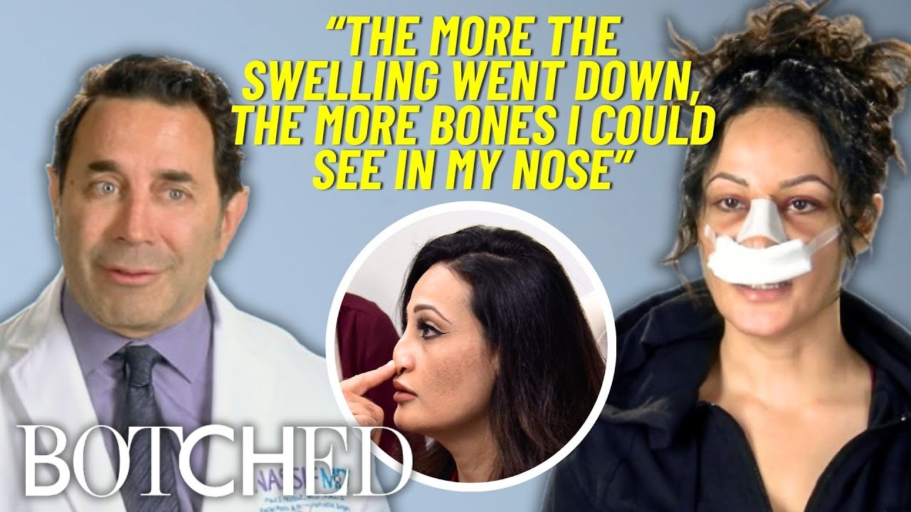 Nesreen&rsquo;s Nose BENT Sideways After a Botched Nose Job | Botched | E!