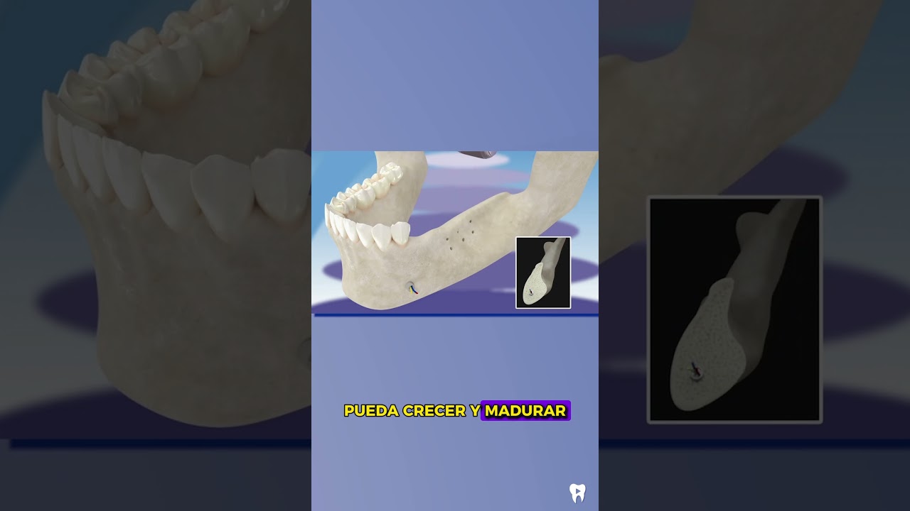 REGENERACI&Oacute;N &Oacute;SEA guiada - T&eacute;cnica para falicitar la COLOCACI&Oacute;N de IMPLANTES dentales