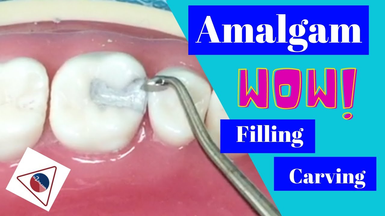 Amalgam Condensation and Carving Technique (Tutorial) | In Office to Hands On Dental Training