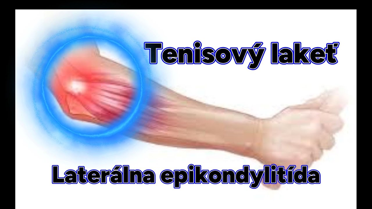 Tenisový lakeť - laterálna epikondylitída (testy, masáž, cviky)