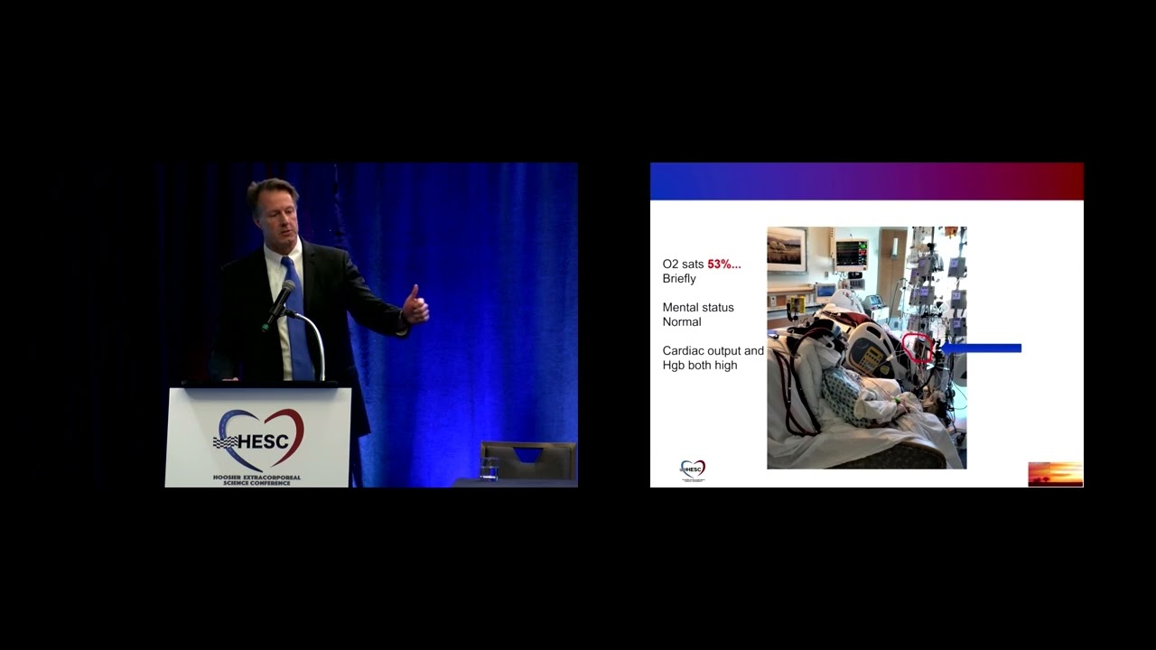 (Common challenges for ECMO patients) presented by Dr. Eric Osborn-HESC May 2022 in Indianapolis, IN