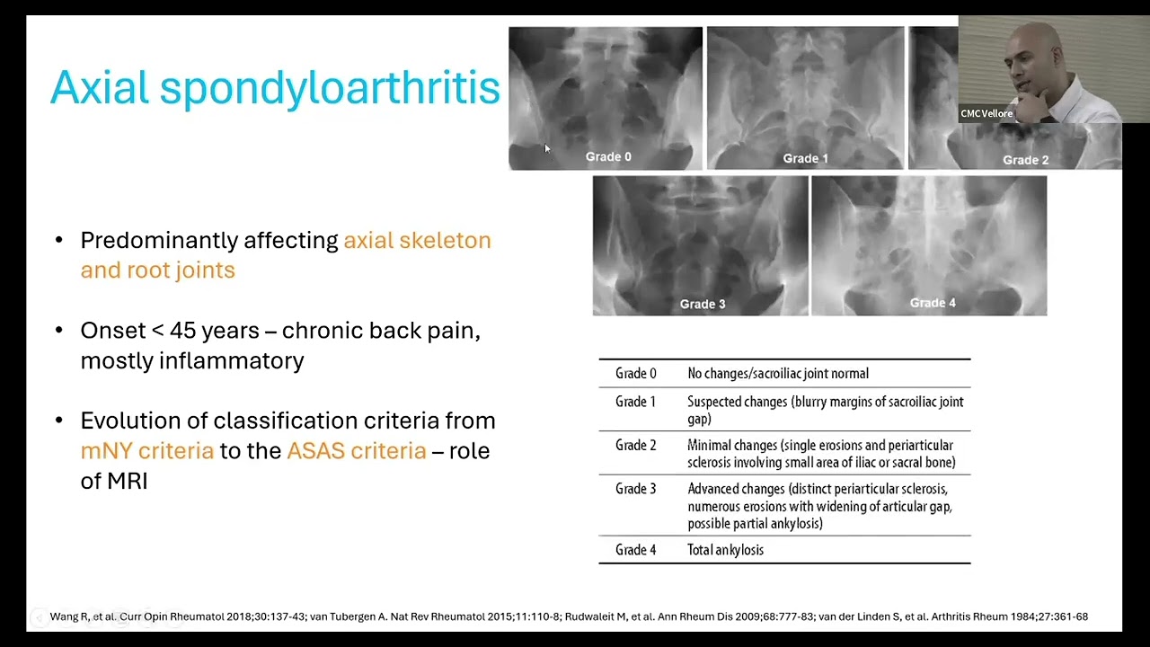 SPONDYLOARTHRITIS - APPROACH AND MANAGEMENT - DR. ASHISH J MATHEW, RHEUMATOLOGY