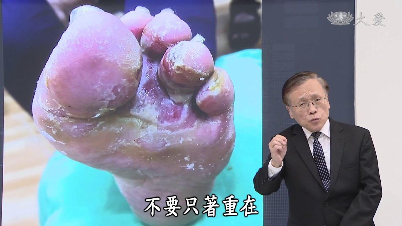 【大愛醫生館】20191213 - 香港腳的危機