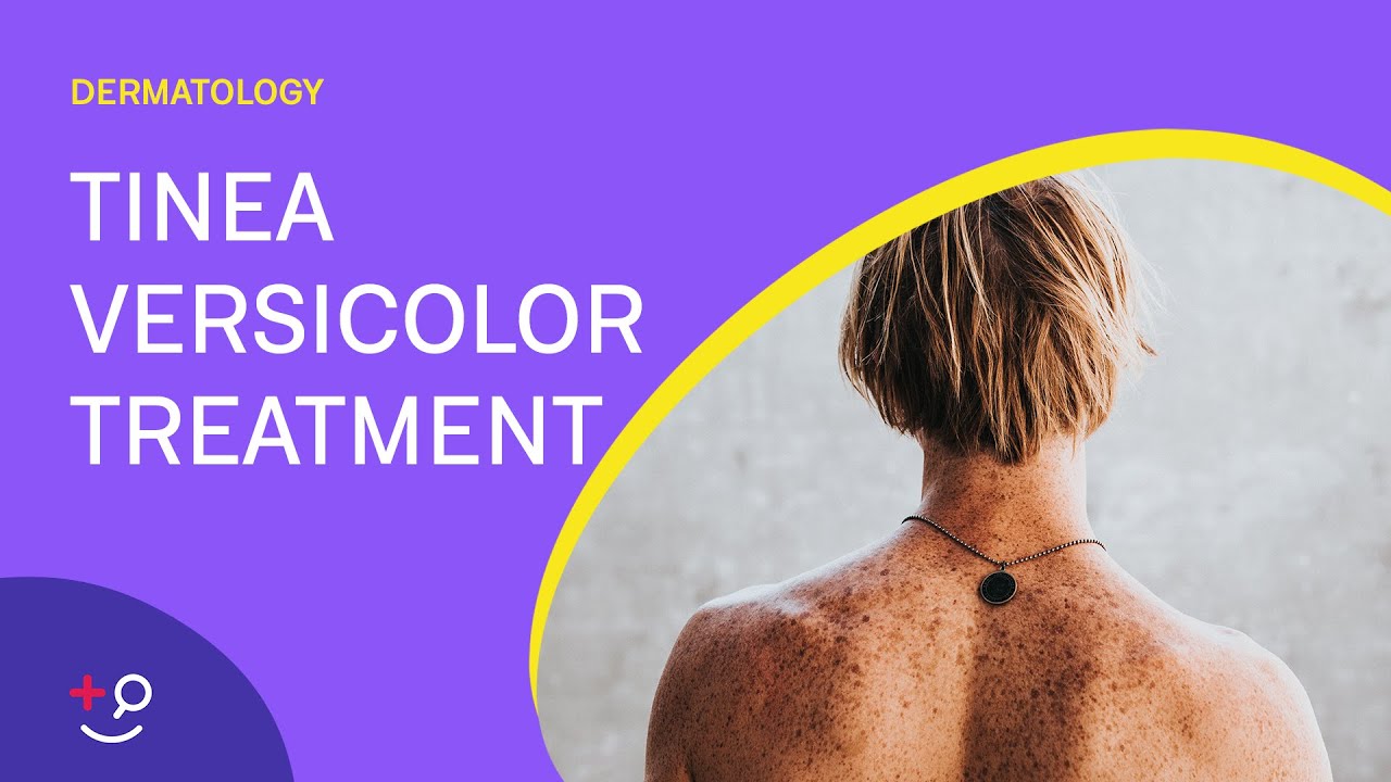 How To Treat Tinea Versicolor?