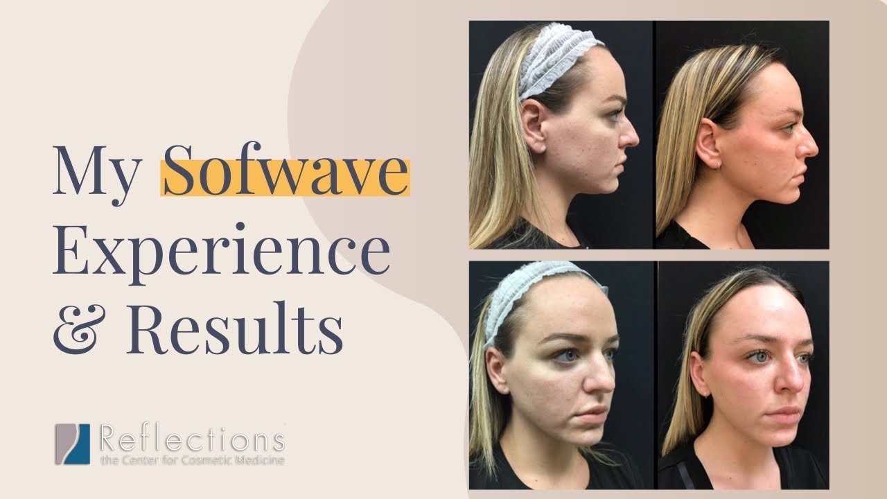My #Sofwave Experience - 