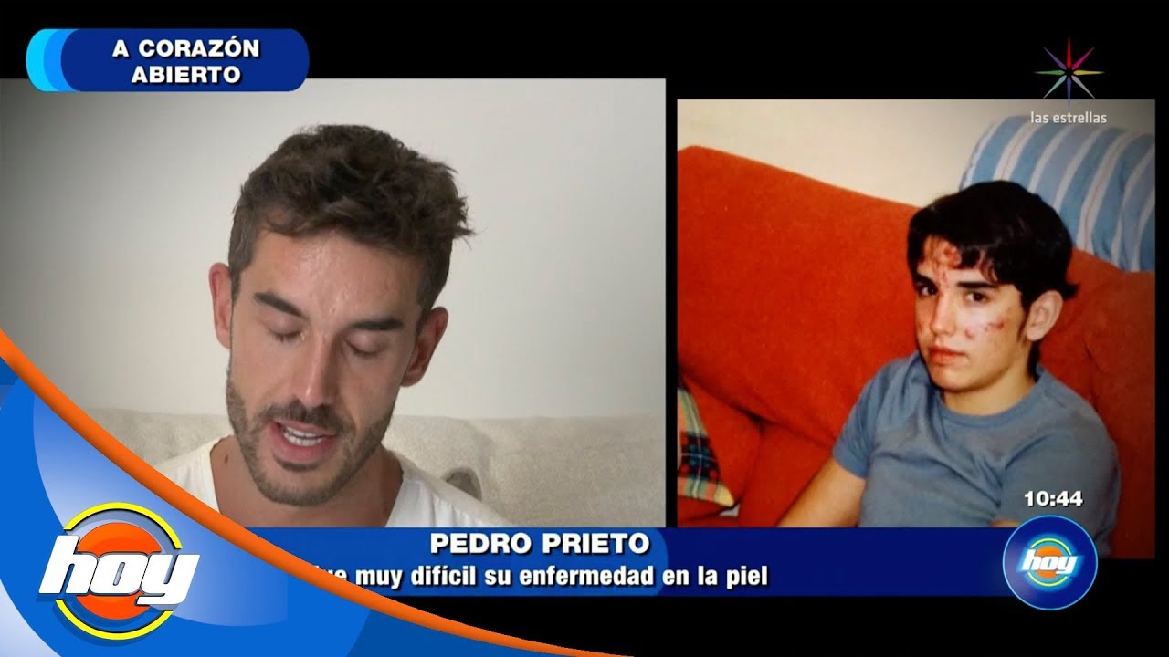 As&iacute; super&oacute; Pedro Prieto sus inseguridades | A coraz&oacute;n abierto | Hoy